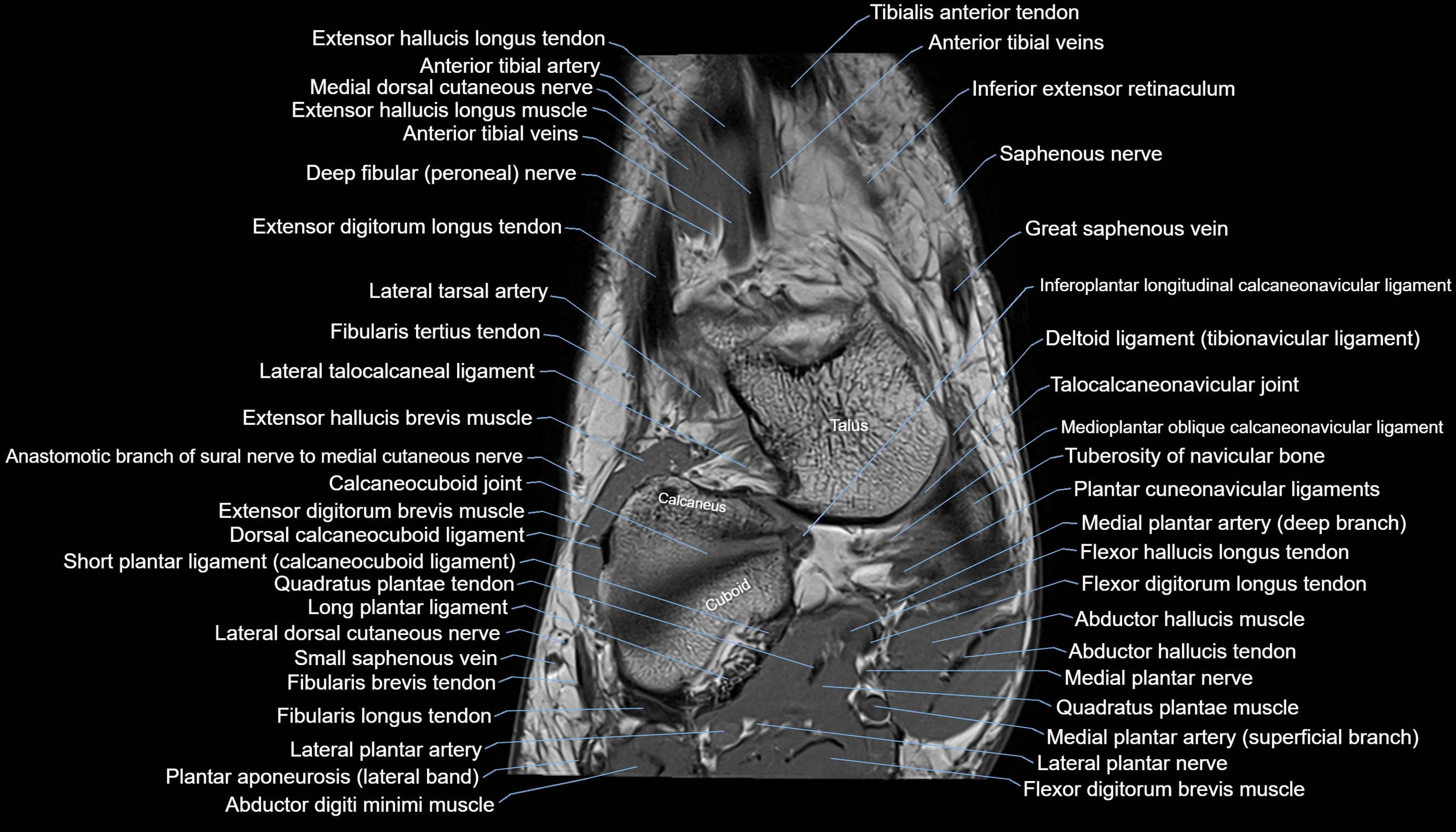 Ankle coronal anatomy 3T MRI images -img-11001-00004.webp